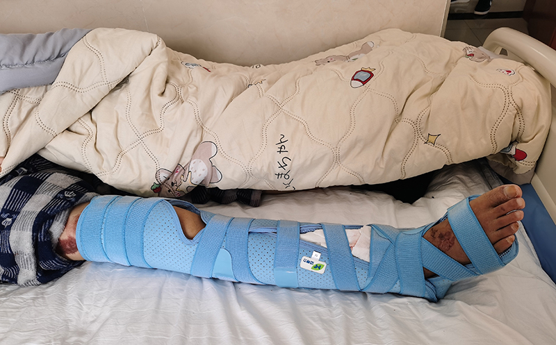 宣威云峰醫院 脛腓骨固定支具